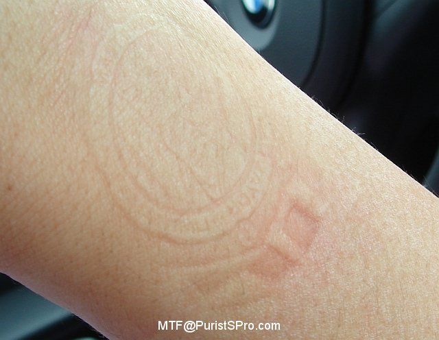 dấu hằn trên da cổ tay khi đeo đồng hồ quá chặt